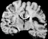 Dilated middle cerebral artery supplying arteriovenous malformation